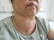 【媒体聚焦】人民好医声-63 | 甲状腺肿大40年，重庆大妈呼吸受阻命悬一线