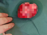 【人民好医声-69】甲状腺癌“躲猫猫”，50岁大叔肩痛竟是癌