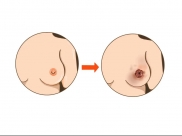 乳头溃烂莫轻视，许是乳癌敲警钟