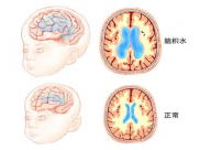 【医说科普】脑积水专病门诊：“脑积水”多数可治好，手术“排水”来帮忙