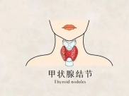 【主题教育·见行动】第8期 | ​守护甲状腺健康 远离颈部“蝴蝶癌”