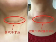 【医者仁心】疗效与美貌兼顾，腔镜甲状腺手术让颈部“疤痕”隐形