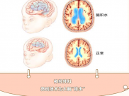 【医说科普】脑积水专病门诊：“脑积水”多数可治好，手术“排水”来帮忙