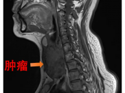 披着良性结节外衣的甲状腺滤泡癌，千万不可大意！